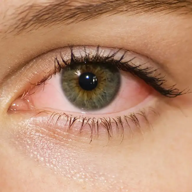 Why Do Some Believe Pink Eye Holds a Spiritual Meaning?