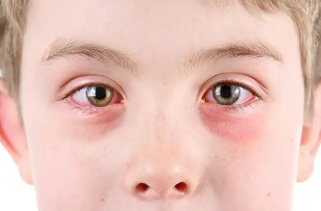 Why Do Some Believe Pink Eye Holds a Spiritual Meaning?